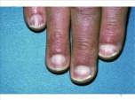 Onychodystrophy grey nails Usually triggered by various prescription drugs such as