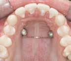How do we proceed in the case of a high gothic palate? When to use a TopJet distalizer 250, when a 360?
