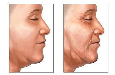 jowls and double chins. The skin of the neck droops into folds and wattles.