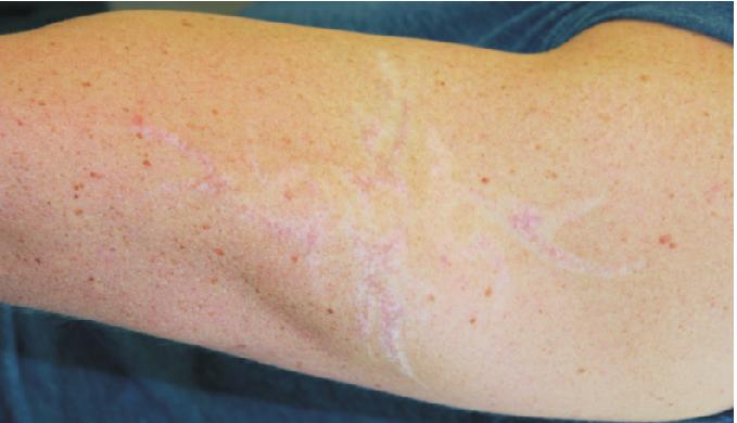 Collagen thermal damage and collagen synthesis after cutaneous laser resurfacing. Lasers Surg Med.998;23(2):66-7. 6. Fitzpatrick RE, Rostan EF, Marchell N.