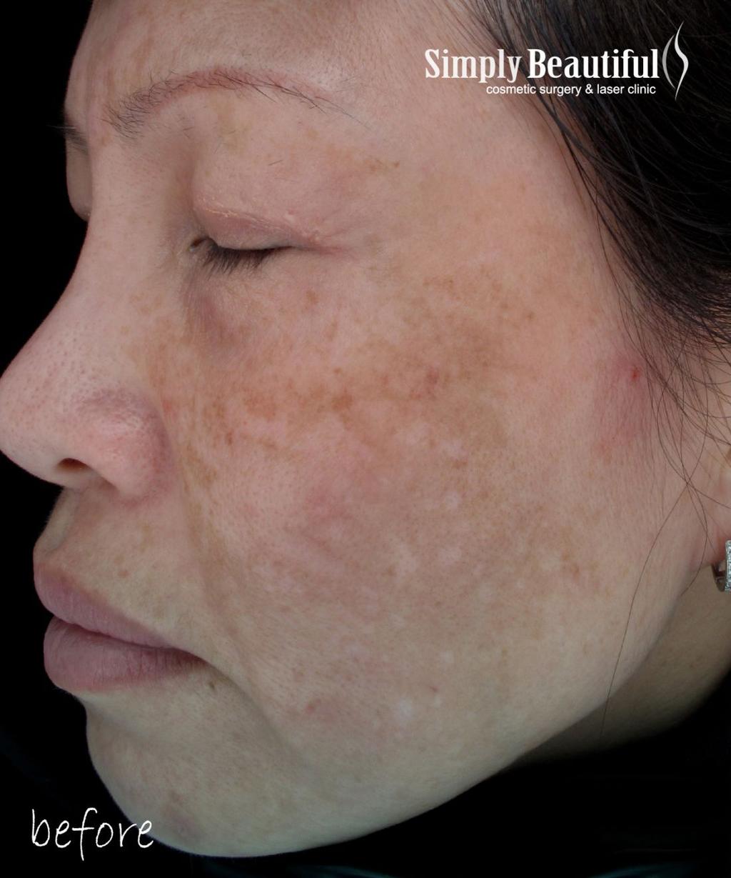 Why treat pigmentation disorder in Asians? My grandma told me.