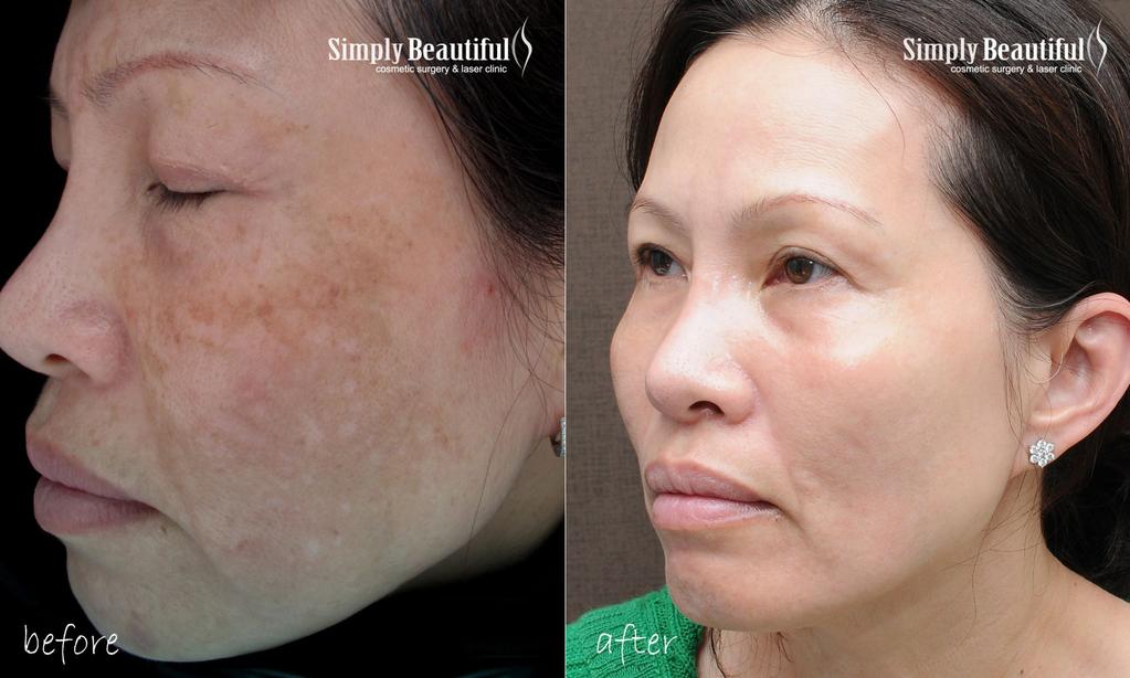 1064 QS Nd:YAG Laser is effective in Asian Skin