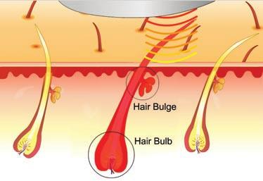 combined energy of the light and heat results in subsequent destruction of the hair follicle.