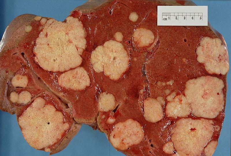Example of Metastasis Primary cancer in