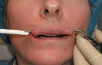 3 Fat transfer is an older procedure that has found resurgence in lip and facial augmentation.
