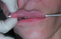 Figure 10D The implant after it is passed through the tunnel. Figure 12 Radical improvement of perioral aging can be achieved with combination procedures.