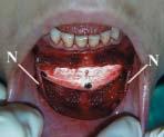 Figure 14 A GORE-TEX chin implant has been placed through an intraoral incision. Note the mental nerves (N) that have been preserved laterally.