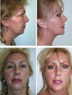 Figure 16 A rhytidectomy (facelift) procedure is required to address sagging jowls and excess neck skin.