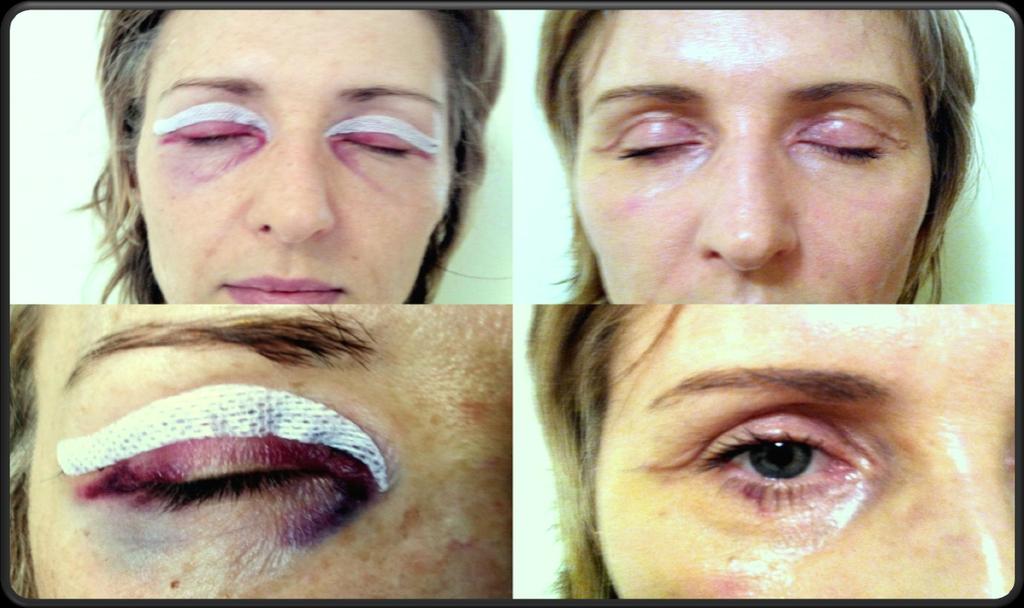 Woman, 40 y. old post-surgical healing after upper-lid blepharoplasty.