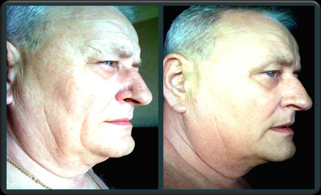 Coherent Enlightened Beauty Treatment Male, 64 y. old, was treated for depression. Ten 1-hour sessions of SCENAR THERAPY in 10 days.