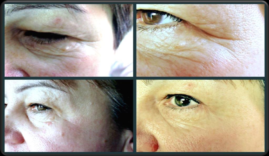 Woman, 54 y. old. Substantial swelling of eyelids, constant tearing. Lymphatic drainage with SCENAR for 5 days for 30 min.