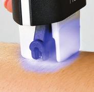 About the Blue and Red Light C The Blue Light under the Thermicon Tip will guide you throughout your treatment. It is visible only when you are gliding no!no! at the proper speed.
