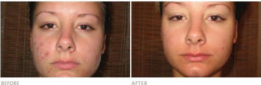 Desire Phelps Desire used the Arbonne Clear Future System and these photos show the results after just one