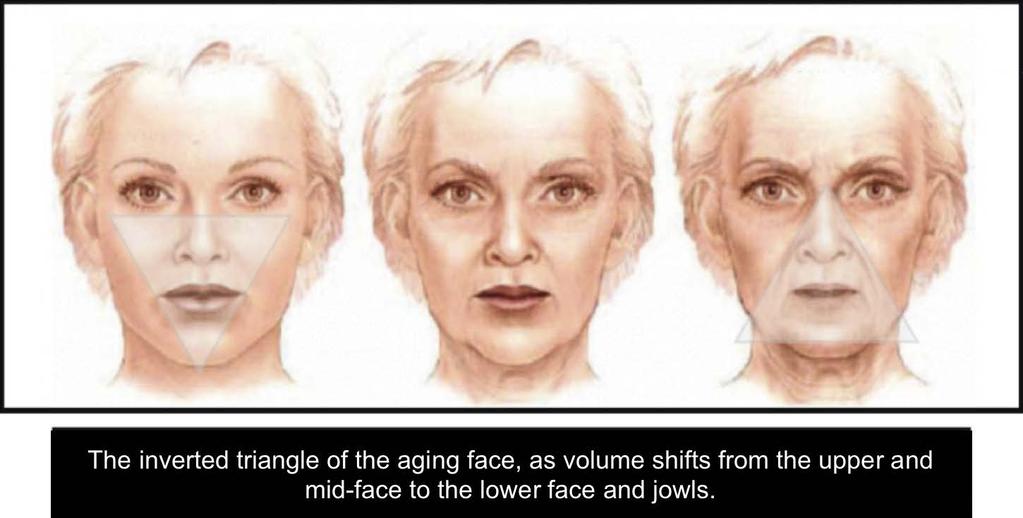 lower face gains volume. This volume shifts results in hollowed areas near the eyes and cheeks. Lines between the nose, mouth and chin will also become deeper and more pronounced.