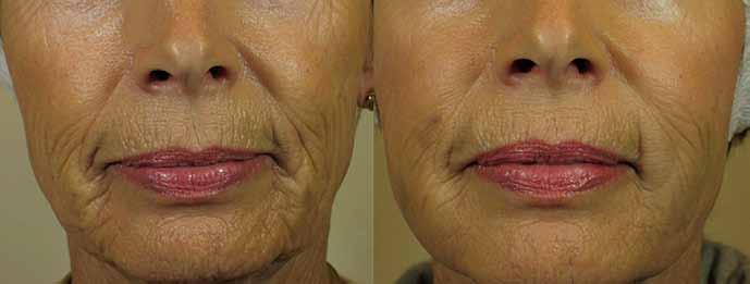 Photos courtesy of Vic Narurkar, MD Fig. 2. Pre and post Juvederm Ultra Plus XC and Juvederm Ultra XC, total four syringes. norm.