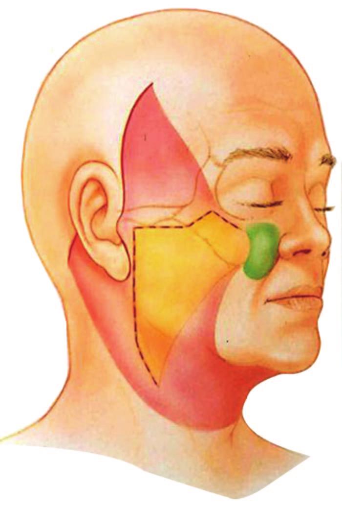 Volume 129, Number 5S Restoring Facial Shape in Face Lifting for this dissection is essentially an extension of a standard SMAS dissection anteriorly and superiorly into the malar region, to allow