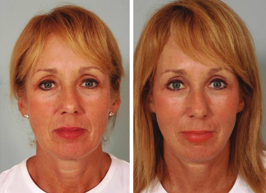 Volume 129, Number 5S Restoring Facial Shape in Face Lifting Fig. 13.