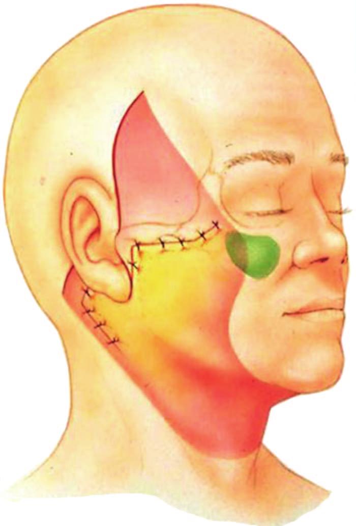 Volume 129, Number 5S Restoring Facial Shape in Face Lifting Fig. 16. Fixation of the superficial fascia affects facial shape.