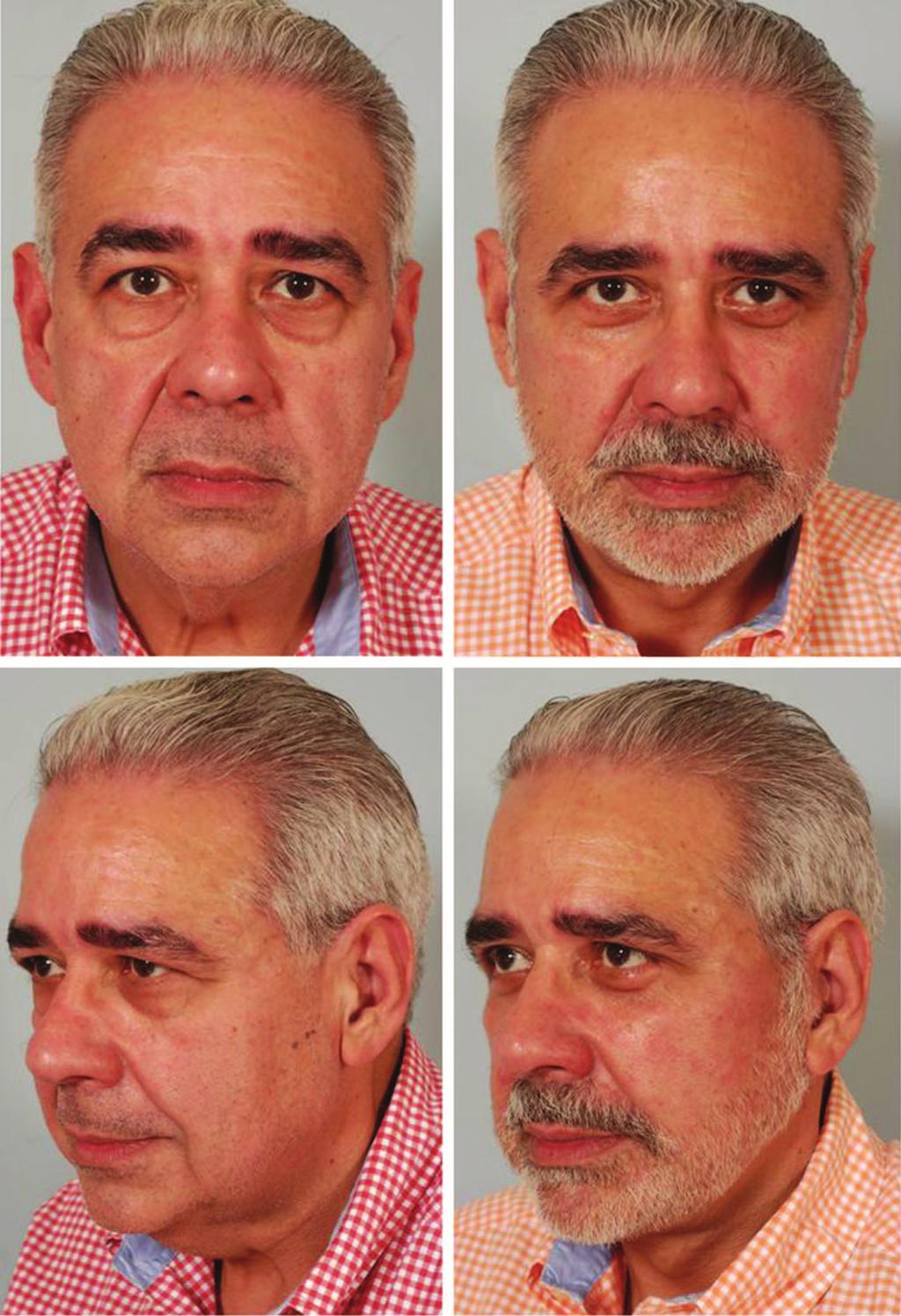 Volume 129, Number 5S Restoring Facial Shape in Face Lifting Fig. 3. (Left) Preoperative appearance of a 59-year-old man after a 90-pound weight loss from a gastric bypass procedure.