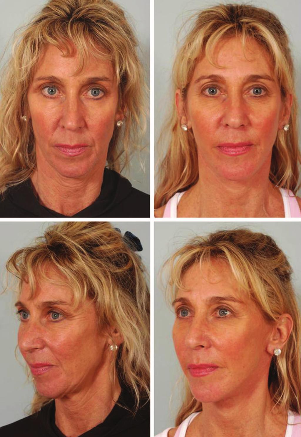 Volume 129, Number 5S Restoring Facial Shape in Face Lifting Fig. 5. Long,thinfacesoftenbenefitfromanenhancementofmalarvolume.
