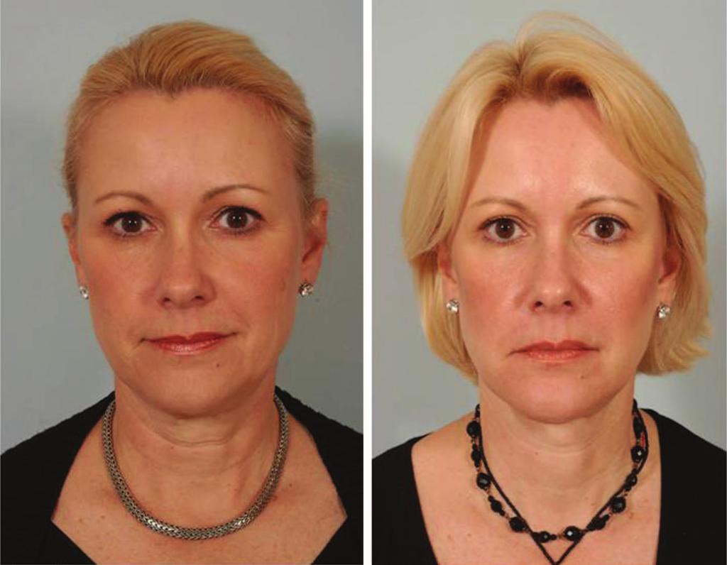 Volume 129, Number 5S Restoring Facial Shape in Face Lifting Fig. 8. (Left) Preoperative appearance.