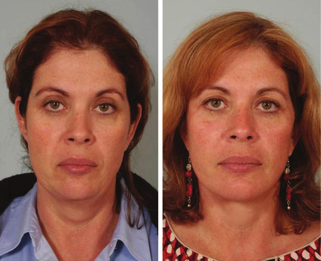(Right) Postoperatively, following malar pad elevation, malar volume is enhanced in association with a restoration of submalar concavity, producing a more angular appearance to facial