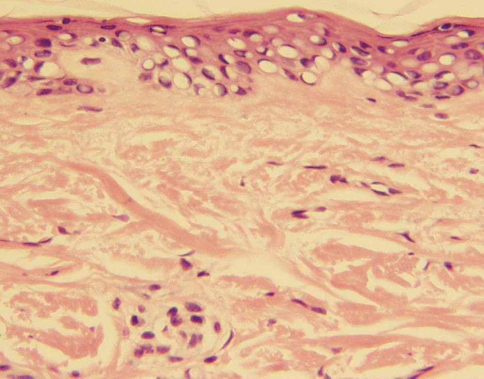 Fig 5. Wide spaces between the collagen bundles and swollen vascular structures demonstrate papillary dermal edema.