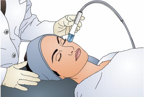 Dermabrasion Introduction Dermabrasion is a procedure that resurfaces a person s skin. A health care provider uses a device known as a dermabrader to quickly sand away the outer layers of skin.