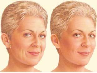 Step 2 The incision Depending on the degree of change you d like to see, your facelift choices include a traditional facelift, limited incision facelift or a neck lift.
