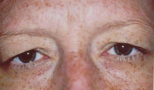 The low position can give you that tired or angry look a condition called Brow Ptosis.