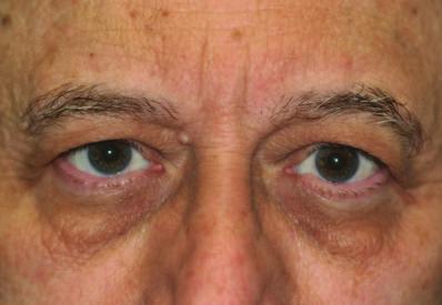 diagnosed mild to moderate brow ptosis, then you may be a candidate for the Endotine Transbleph procedure.