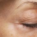 Instantly reduce the appearance of fine lines and wrinkles without needles or