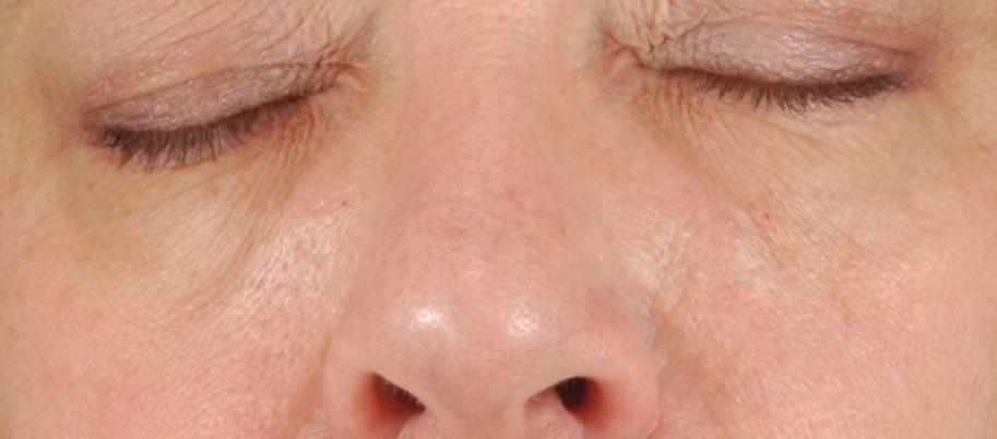 Clinical Photography Benefits from Injectable Therapy Benefits from AHA Peels Glabellar lines injected with botulinum toxin type A (0 units) and nasolabial folds injected with hyaluronic acid filler