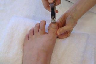 trim the free edge. Use multiple small cuts beginning on one side working your way to the other side. This technique avoids flattening the nail which could injure the nail bed.