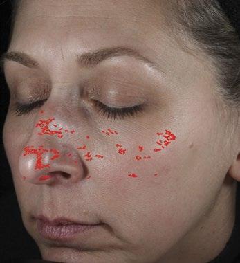 ** In just 2 weeks, reveal dramatic results you can see: Texture Baseline Red marks indicate rough skin texture.