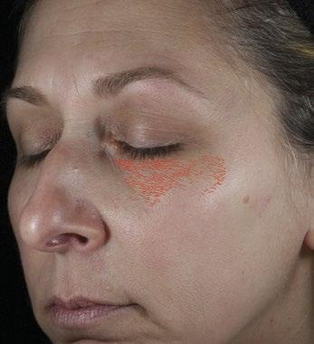 At 2 Weeks Reduction of red marks indicates diminished appearance of fine lines and crow s feet around eyes.