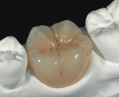 4. Outer Staining Interproximal, cervical and occlusal applications