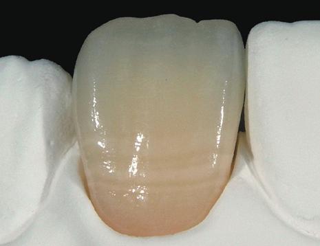 application of white bands and decalcifications To create white or