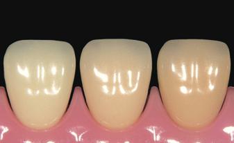 Shade Stains (AS, BS, CS, DS, RS) Shade Stains are recommended for the shade adjustment of finished ceramic restorations.