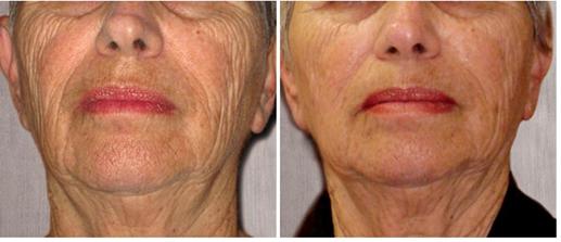 Figure 3: A 71- year old female; (Left) prior to first treatment; (Right) following two treatments.