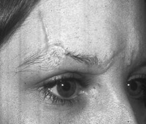 The scars depicted in this patient required two stages.