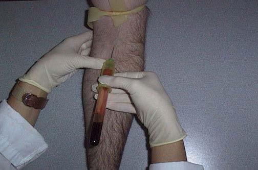 Performing Venipuncture Use thumb to pull skin taunt or anchor from under the arm. The vein is anchored and the needle is inserted.