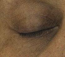 improvement in the appearance of wrinkle severity 75% showed improvement in the appearance of total wrinkle count 83% showed improvement in the appearance of crow s feet 91% showed