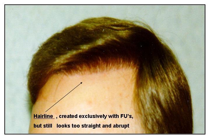 Our ability to create a natural hairline has dramatically increased over the years. Many of us promise full and undetectable hairlines in our promotional materials.