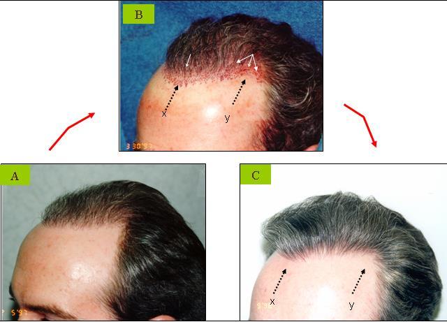 10 Fig 13 A, B : PROPER PLACEMENT OF THE FRONTO-TEMPORAL ANGLE IN SEVERE HAIR LOSS: (A) It is difficult to know where to place the apex of the fronto-temporal angle in severe hair loss where the