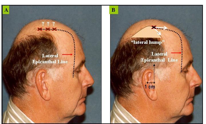 (B) Visualizing and recreating the lateral hump gives you a helpful landmark to intersect Visualizing and recreating such a lateral hump gives the lateral epicanthal line a target to intersect.