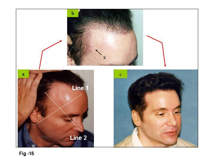 RECREATING A RECEEDED TEMPORAL HAIRLINE AND TEMPORAL POINTS Recession of the temporal hairline and temporal points can contribute a great deal to the appearance of baldness by making the forehead