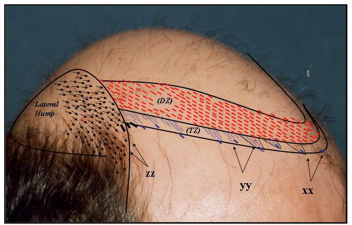 first and than move to the fine trim last. Incisions in the defined zone are placed in a staggered pattern at a density of approximately 25 FU s/cm 2 creating organized disorder.