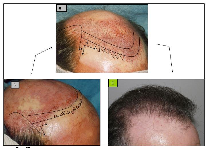 14 Fig -17 shows the results after one session of the patient whose steps where documented in Fig - 16A,B,C. Figures 18 and 19 show further examples of hairlines created with this approach. Figs.