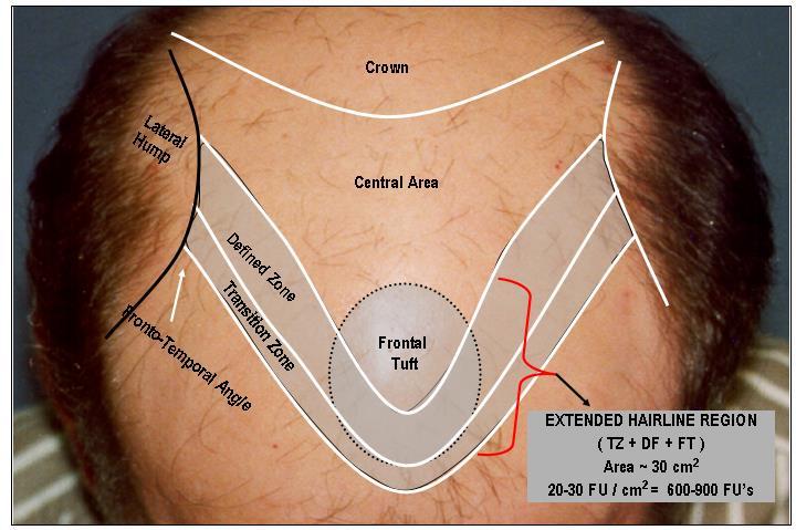 2 FIG-2: EXTENDED HAIRLINE ZONES: I conceptualize an extended hairline as consisting of the Transition Zone (TZ), Defined zone (DZ) & the Frontal Tuft (FT). The TZ should be soft and irregular.